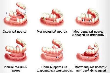 виды зубного протеза