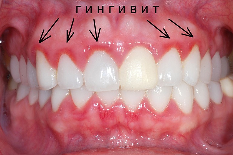 Гингивит: причины, симптомы, лечение и профилактика — Блог стоматологической клиники «Стомос»